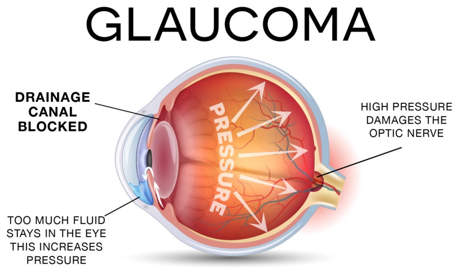Glaucoma surgery in Hadapsar,Pune